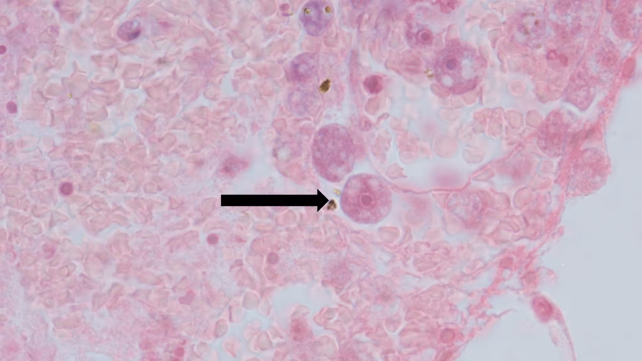 Acanthamoeba-Image 2 High resolution of Acanthamoeba in a patient's brain.