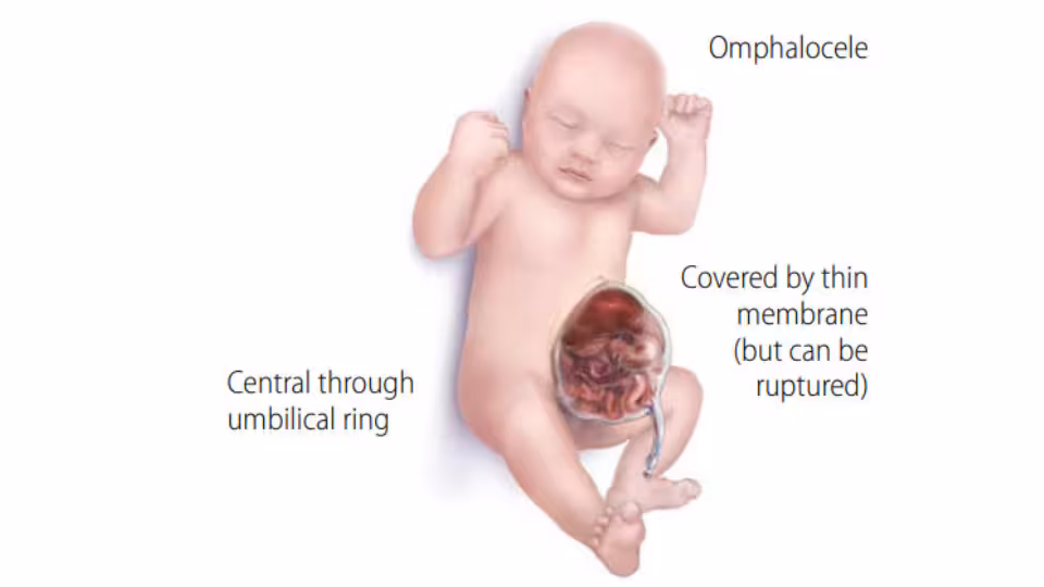 Labeled Illustration Omphalocele Illustration of infant with omphalocele. Text on the graphic reads omphalocele, central through the umbilical cord, covered by a thick membrane (but can be ruptured).