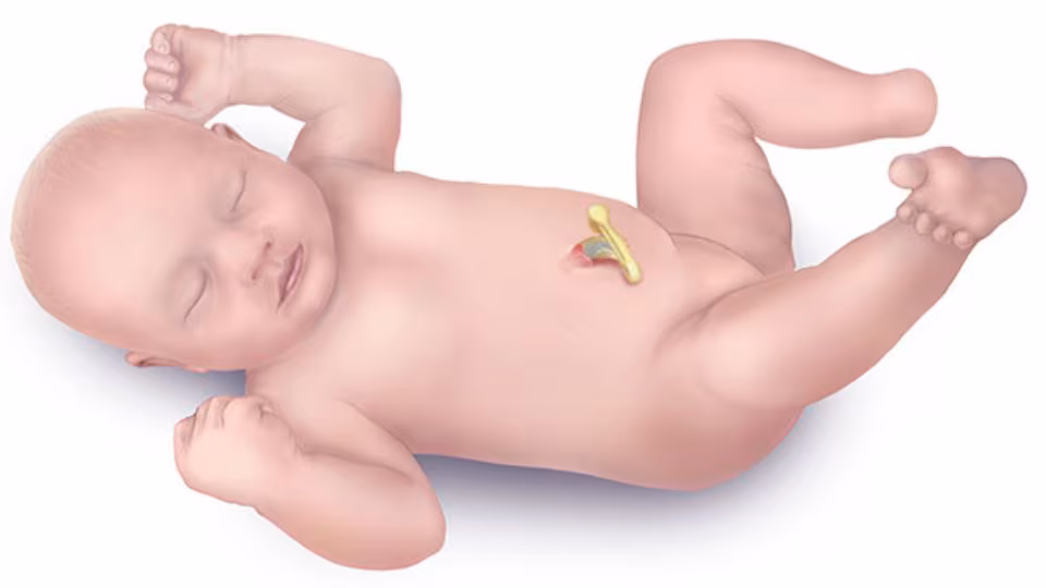 Illustration of a newborn with congenital absence of one foot.
