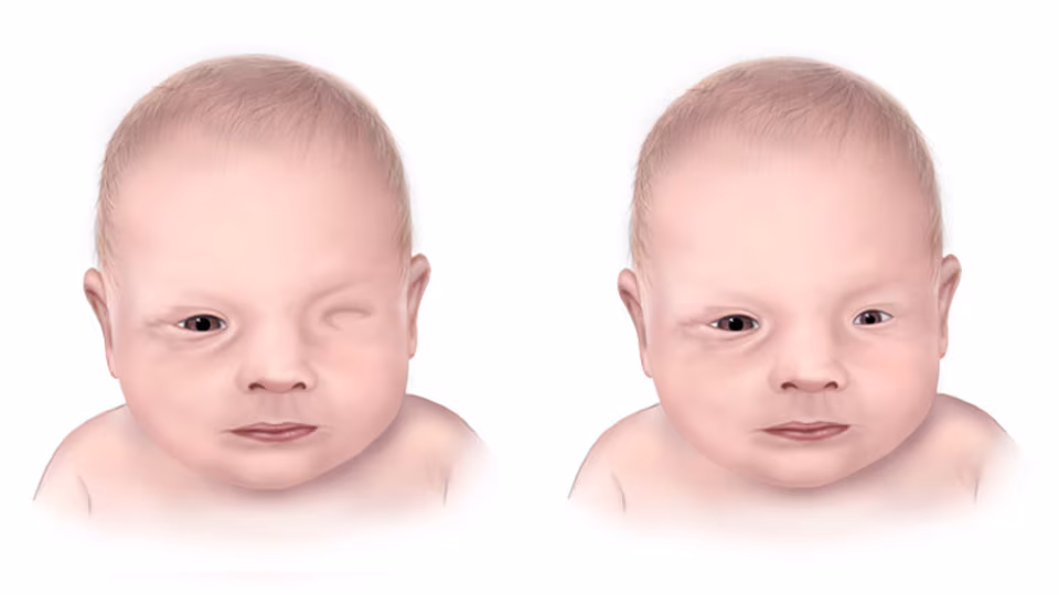 Illustration of two babies with anophthalmia. One baby is missing one eye and the other baby has microphthalmia, where one eye is very small.