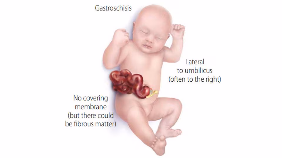 Medical illustration of infant with gastroschisis.