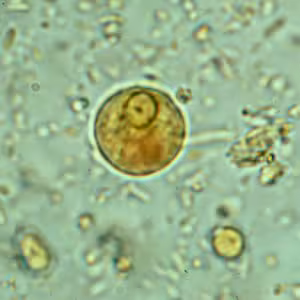 Ehistdisp_cyst_wtmt.jpg