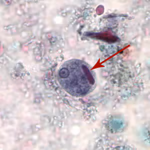 Ehistdisp_cyst_tric.jpg