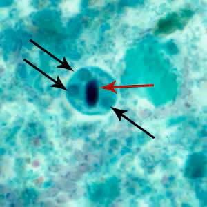 Ehistdisp_cyst_tric2.jpg