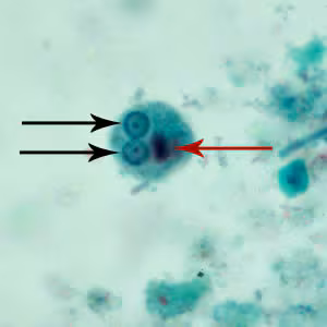 Ehistdisp_cyst_tric3.jpg