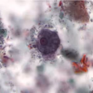 Ehistdisp_cyst_tric4.jpg