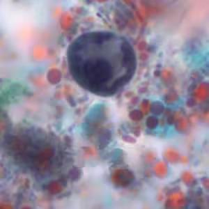 Ehistdisp_cyst_tric5_KS.jpg