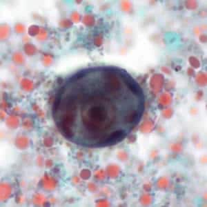 Ehistdisp_cyst_tric6_KS.jpg