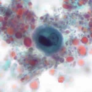 Ehistdisp_cyst_tric7_KS.jpg