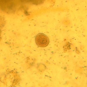 C_mesnili_cyst_wtmt_BM2.jpg