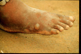 Dracunculiasis1_DPDx.jpg