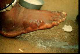 Dracunculiasis2_DPDx.jpg