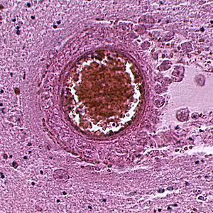 Balamuthia_cyst_HE_Vish2.jpg