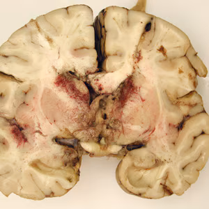 Brain_pathology_Cook2.jpg