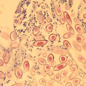 Figure D: Eggs of C. hepatica in liver stained with H&E.
