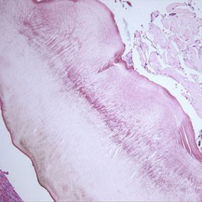 Myiasis_tissue_NYC1.jpg Figure A
