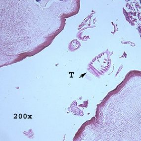 Myiasis_tissue_NYC2.jpg Figure B