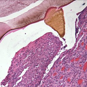 Myiasis_tissue_NYC4.jpg Figure D