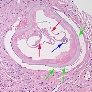 Onchocerca_nodule_HE_PA.jpg