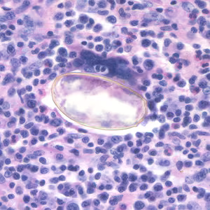 Paragonimus_egg_lung_biopsy2.jpg