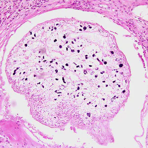 Sparganosis_groin_Paraguay_BAM1.jpg