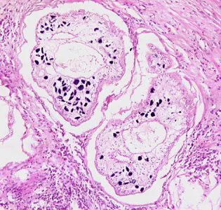 Sparganosis_groin_Paraguay_BAM2.jpg