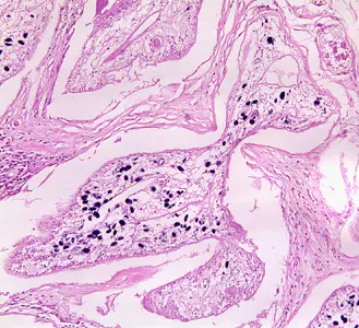 Sparganosis_groin_Paraguay_BAM3.jpg