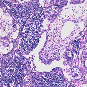 Sparganosis_lung_Taiwan_BAM1.jpg