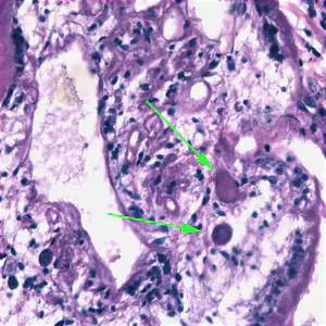 Sparganosis_lung_Taiwan_BAM4.jpg