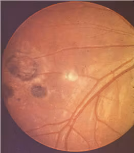 Congen_Toxo_ocular2.jpg