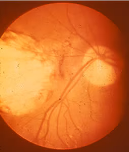 Toxo_ocular.jpg