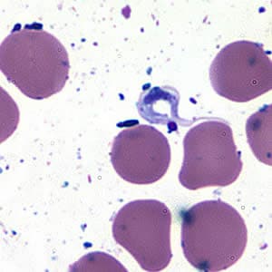 Tcruzi_CSF_giemsa2.jpg