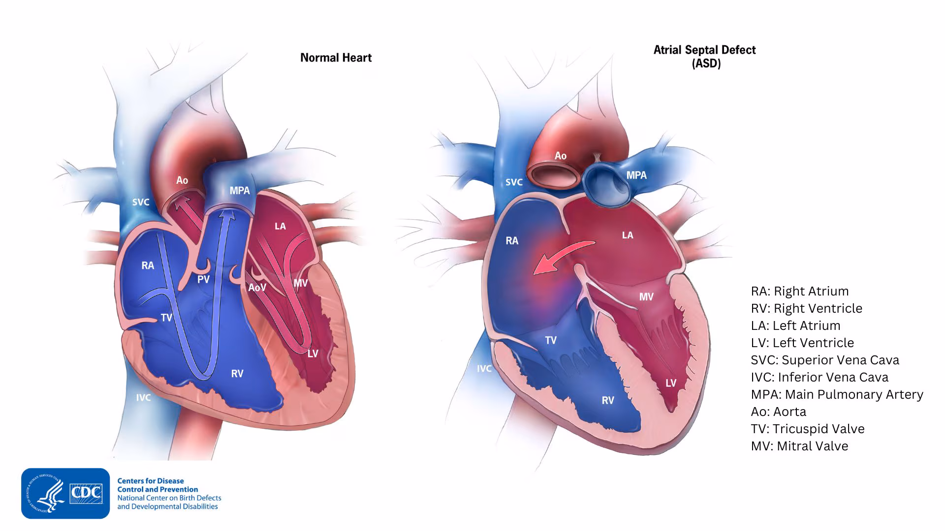 — title missing — Comparison of a normal heart and one with an ASD