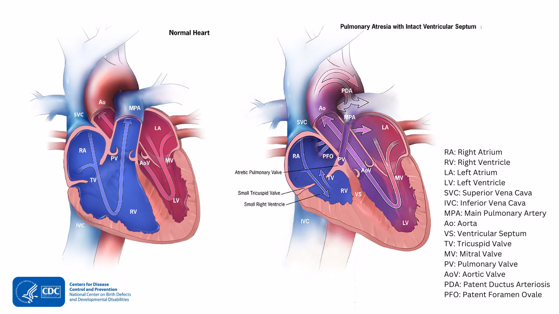 Diagram showing heart with pulmonary atresia and a normal heart Diagram showing heart with pulmonary atresia and a normal heart