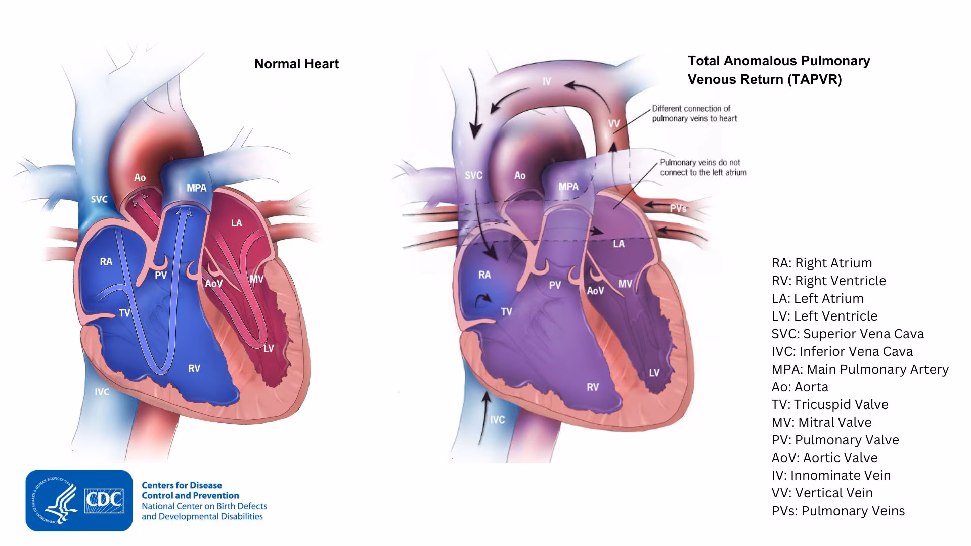 — title missing — Comparison of a heart with TAPVR to a typical heart