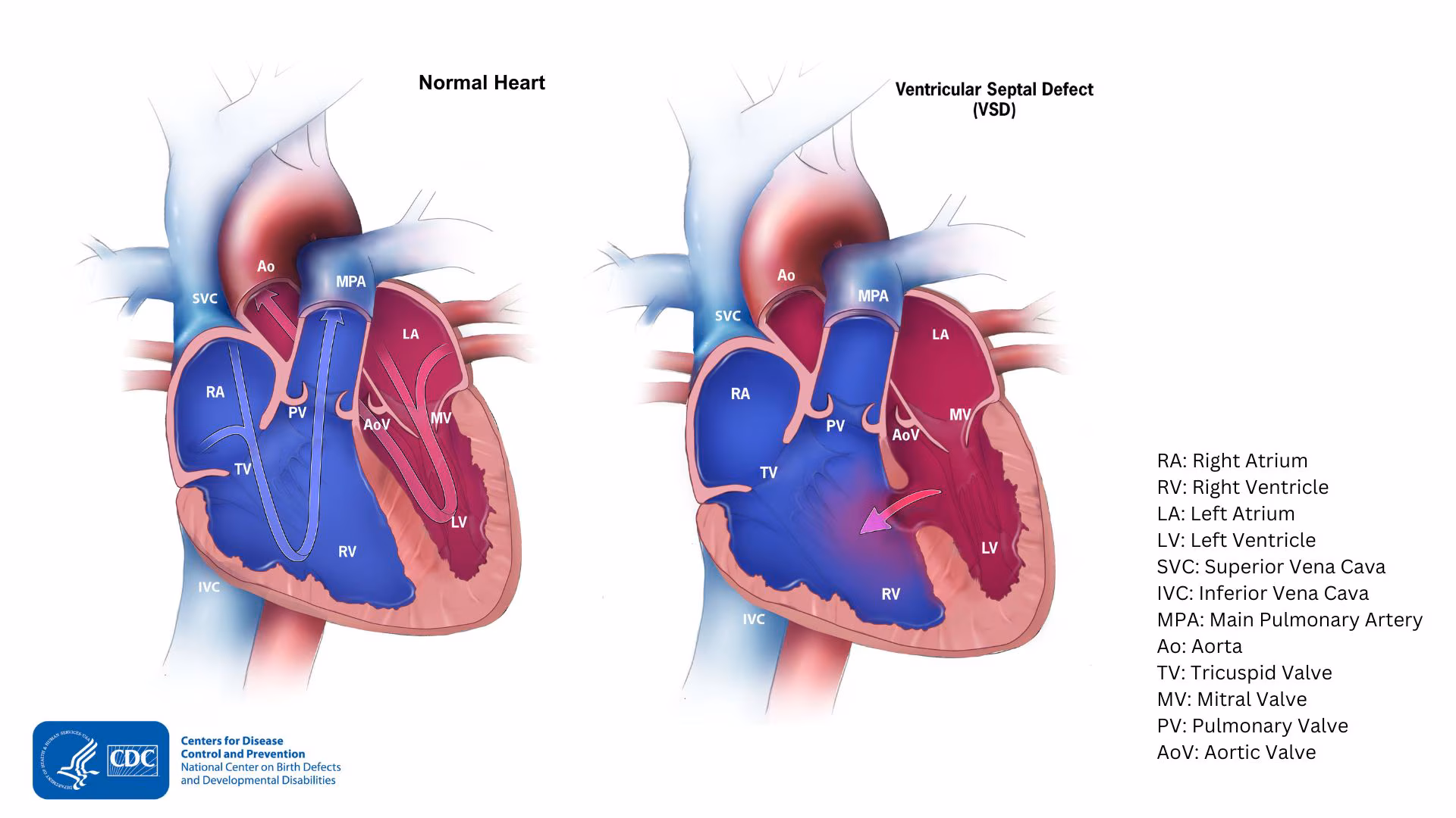 — title missing — Normal heart compared with a heart with VSD