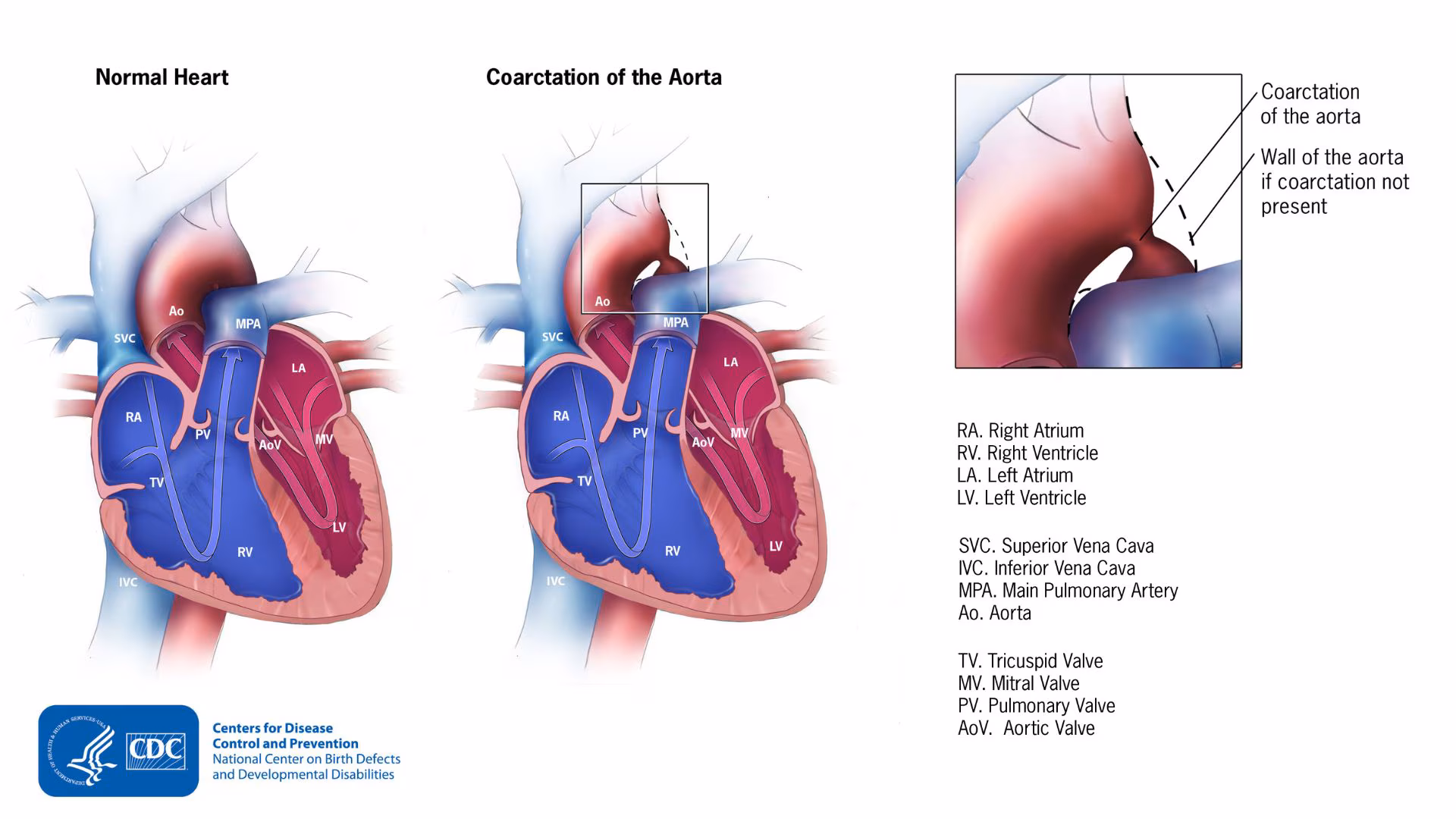 Normal heart to the left, heart with a coarctation of the aorta in the middle, and an enlarged view the coarctation in the upper right