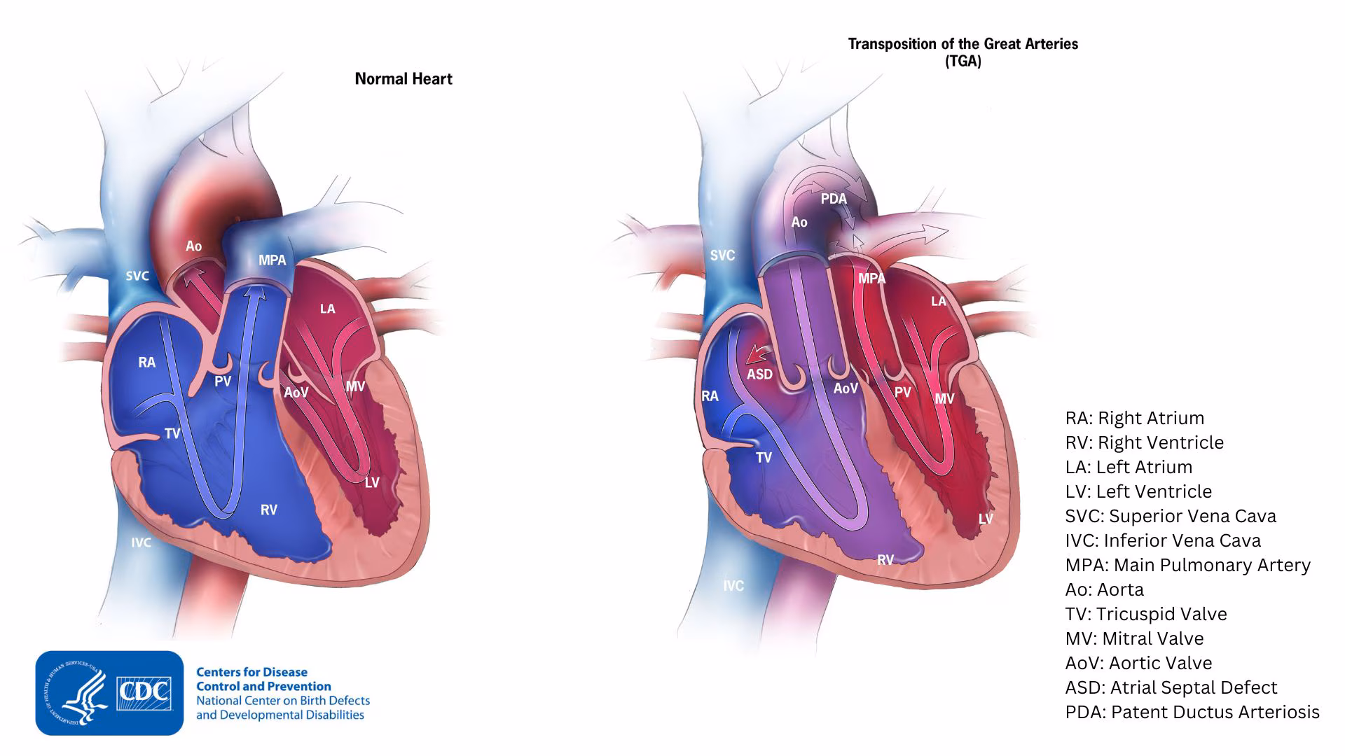 Illustration of d-TGA compared to a typical heart