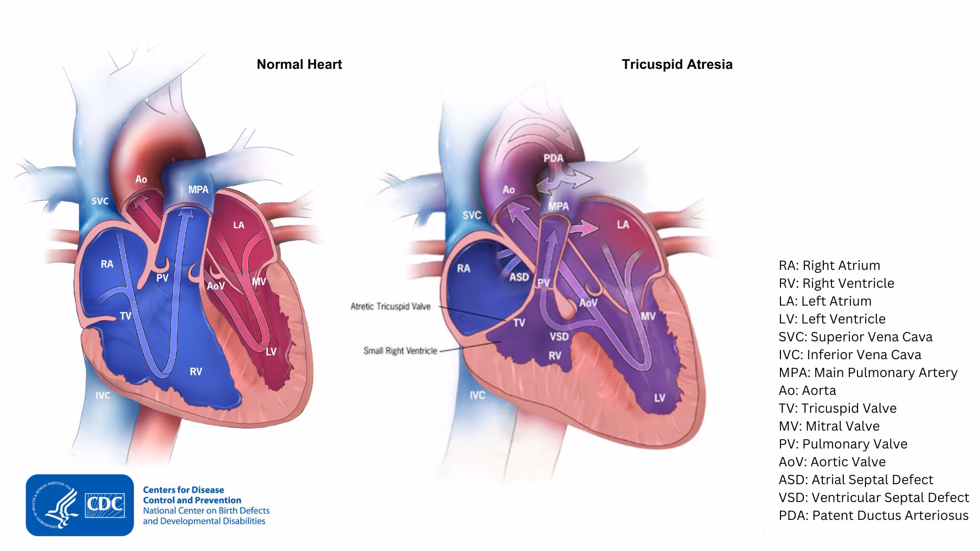 — title missing — Comparison of a typical heart and tricuspid atresia