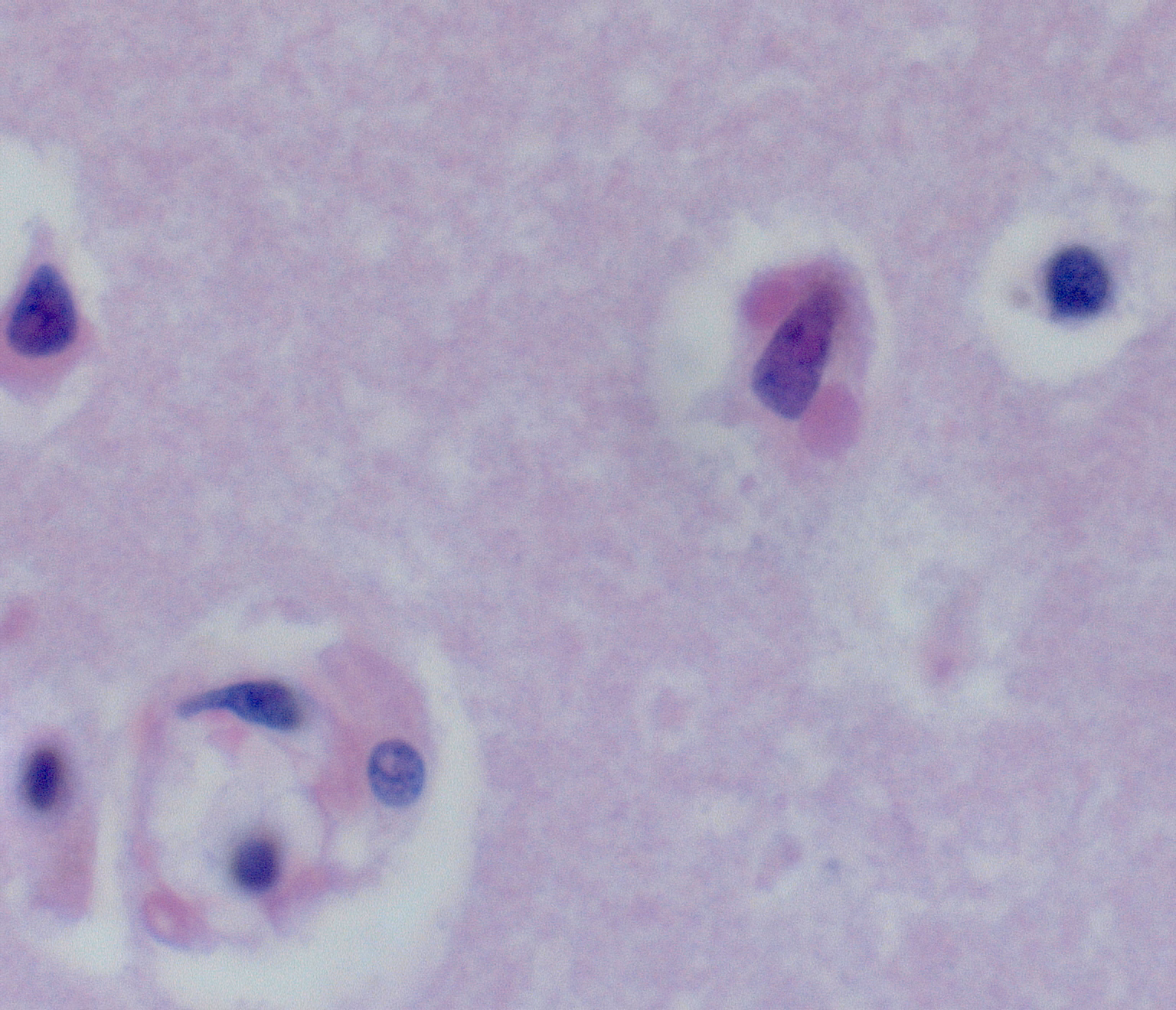 Neuron with Negri body inclusions of rabies virus in the brain of an organ donor