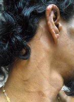 Visible enlargement of the great auricular nerve due to infection with M. leprae.