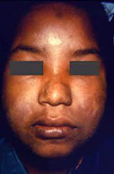 This young woman presented with a case of borderline Hansen’s disease with bilateral involvement of the patient’s buccinator, or cheek muscles, as well as dermatomyositis evidenced by the cutaneous rash-like discoloration overlying the muscles beneath.
