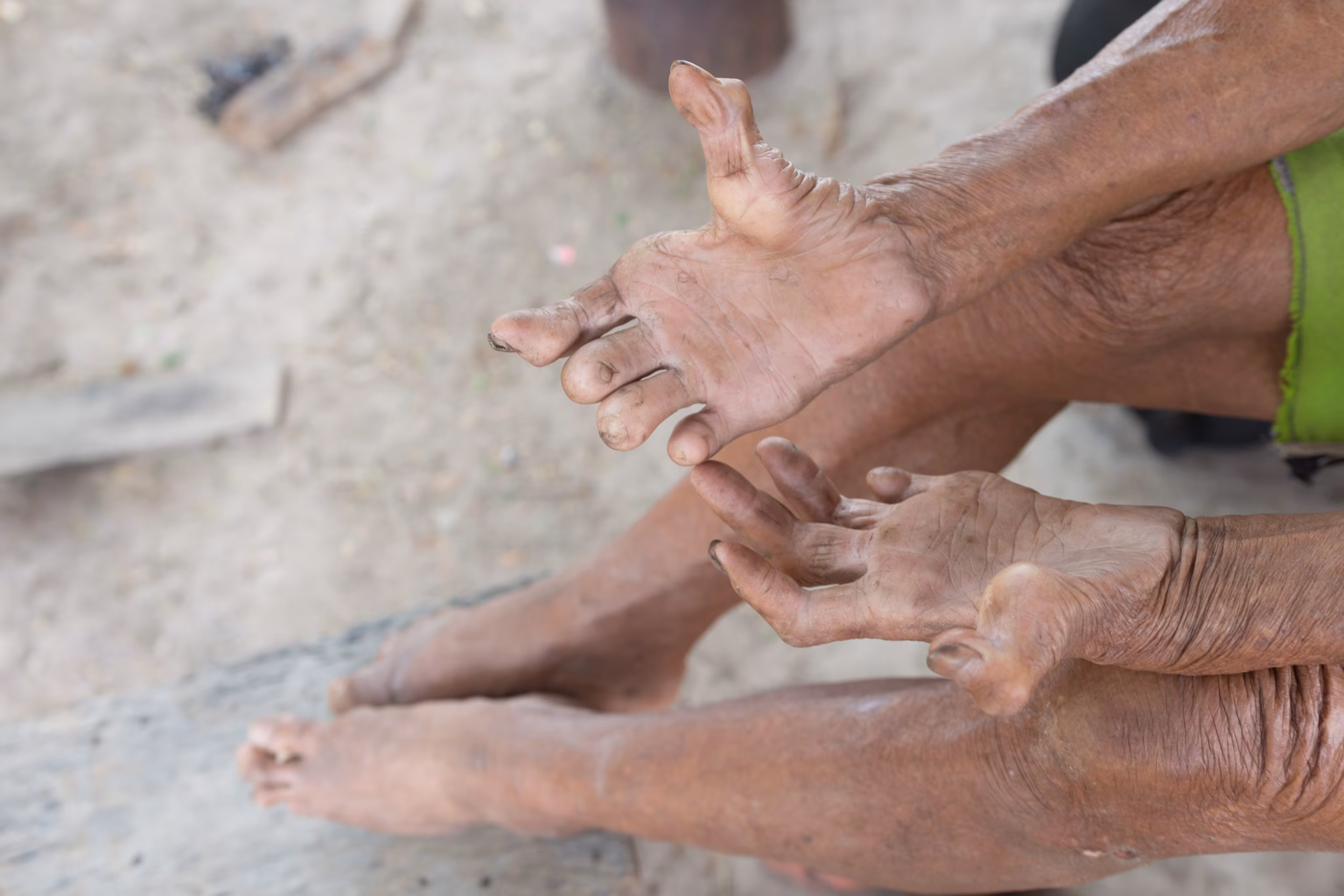 A person with untreated Hansen's disease shows their hands and feet.
