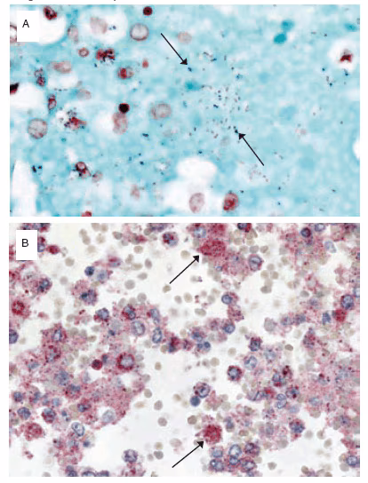 The Figure consists of two slides showing Streptococcus pneumoniae infection in a patient with confirmed pandemic H1N1 virus infection.