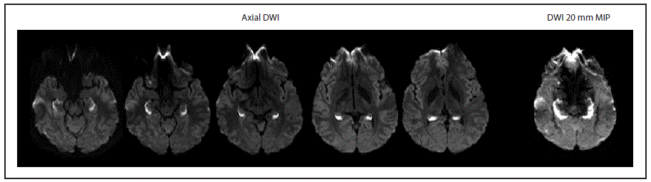 m6603a2f.gif The figure above is a scan showing diffusion-weighted imaging findings at the initial brain magnetic resonance imaging of a patient with unusual amnestic syndrome in Massachusetts during 2012.