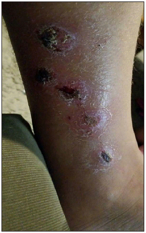 mm6812a2-F The figure is a photograph showing a Corynebacterium diphtheriae–infected lower leg wound in a patient from New Mexico in 2018.