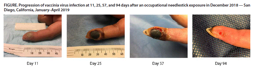 mm6842a2-F The figure consists of a panel of photos showing the progression of vaccinia virus infection in a finger at 11, 25, 57, and 94 days after an occupational needlestick exposure in December 2018, in San Diego, California, during January–April 2019.