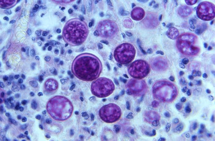 Coccidioides immitis Under a magnification of 500X, this photomicrograph of a periodic acid–Schiff (PAS)-stained lymph node tissue sample, revealed the presence of a number of Coccidioides immitis (the fungus that causes Valley fever) spherules in various stages of development.