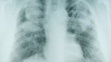 Lung X-ray of Miner Lung x-ray showing pneumoconiosis in coal miner.