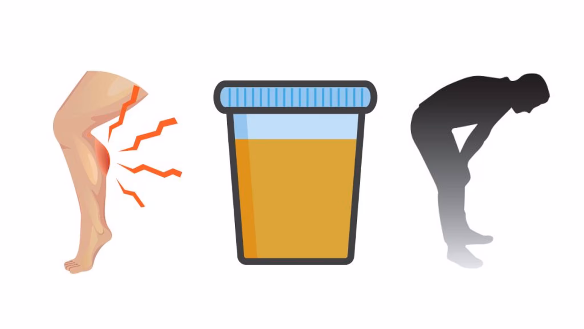 Leg pain, dark urine, and feeling weak or tired are rhabdo symptoms.